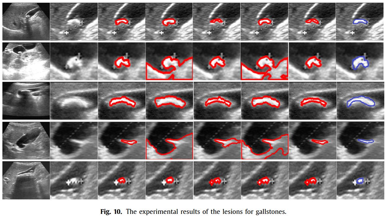 The experimental results of the lesions for gallstones-rnztpegw.png