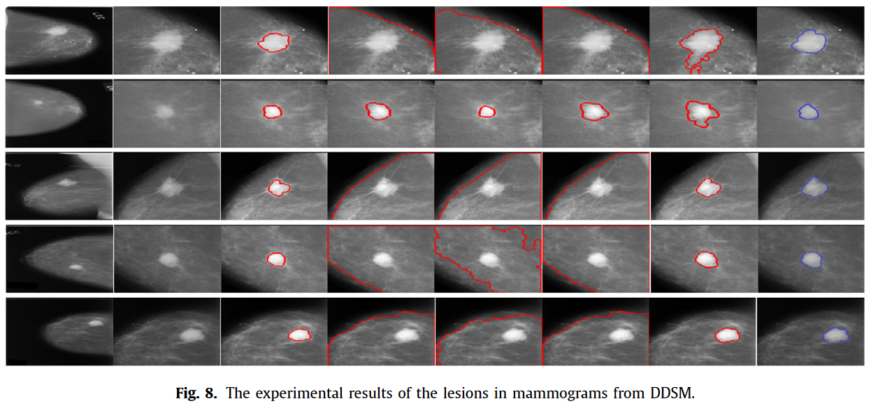 The experimental results of the lesions in mammograms from DDSM-zlcxyloc.png