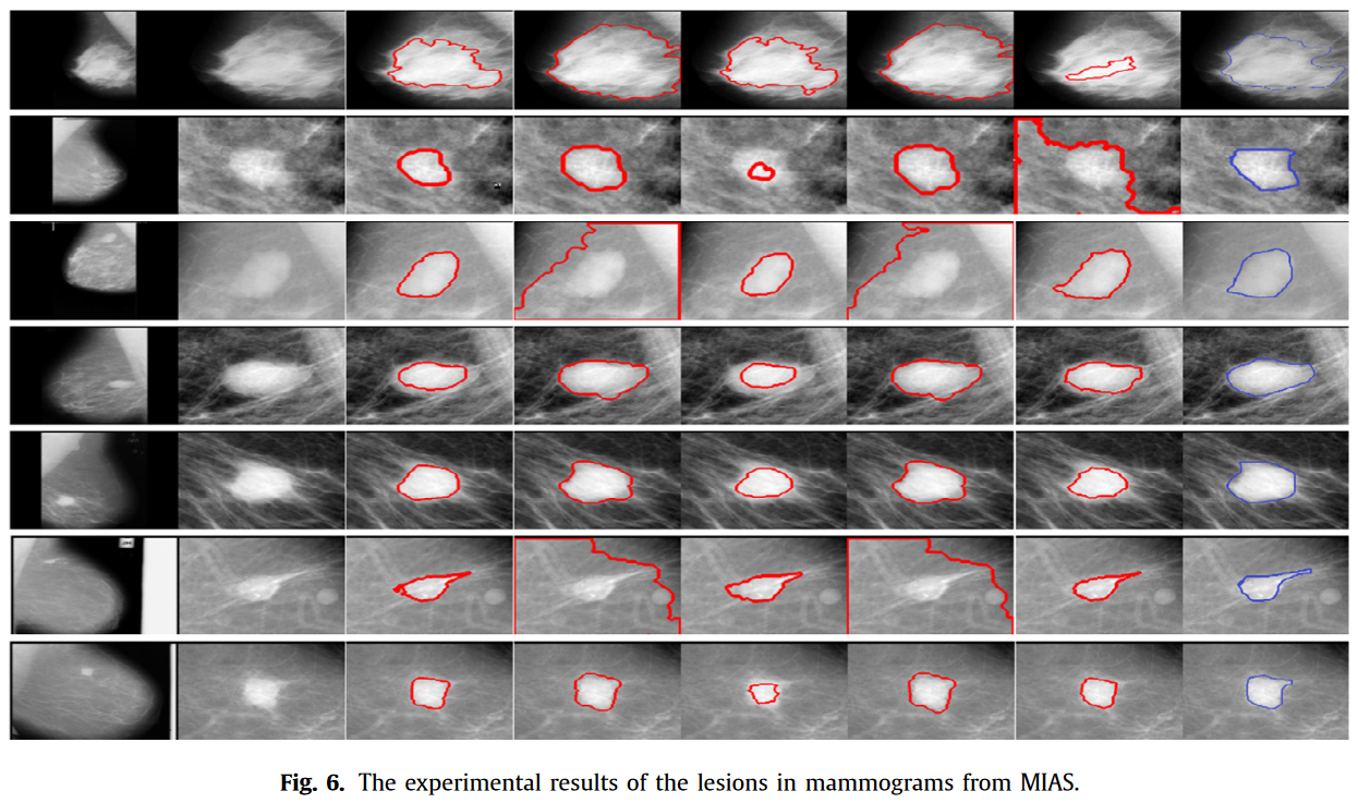 The experimental results of the lesions in mammograms from MIAS-qeyomexr.png